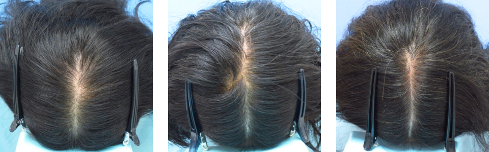 初診時6ヵ月後17ヵ月後