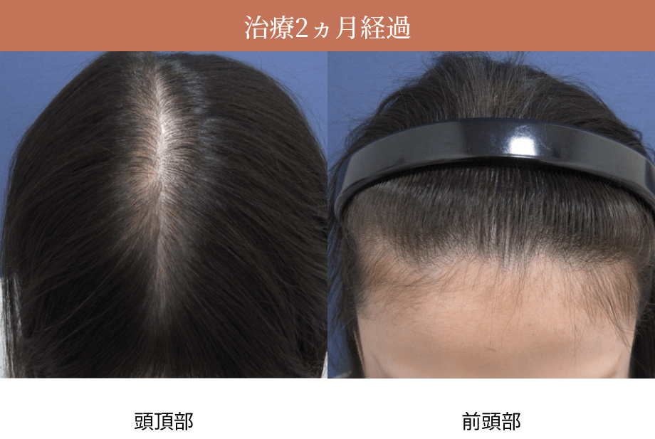 治療2ヵ月経過時の頭頂部・前頭部の画像