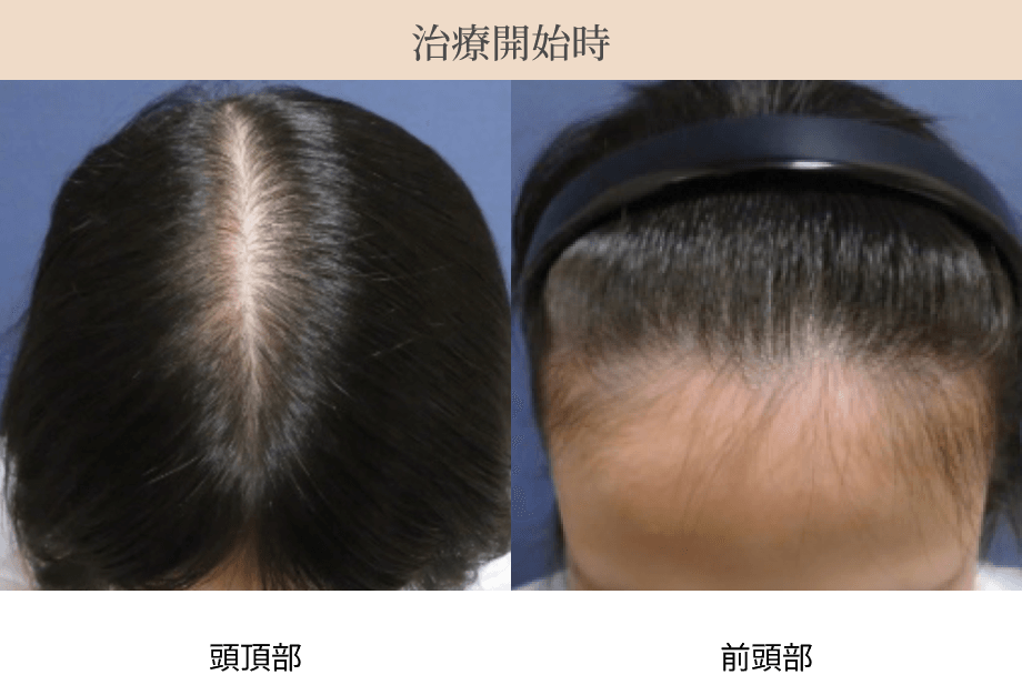 治療開始時の頭頂部・前頭部の画像