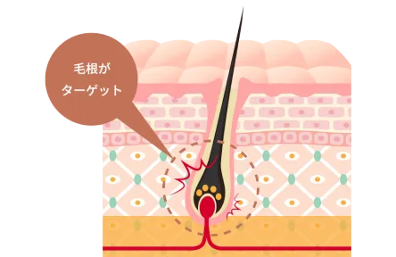 毛根組織を破壊して脱毛