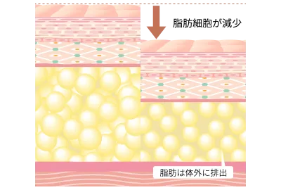 脂肪を溶解して小顔に